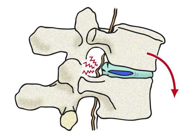 vertebras copia